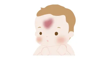 サーモンパッチ