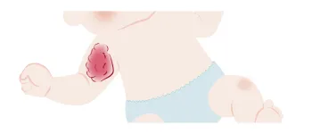 イチゴ状血管腫